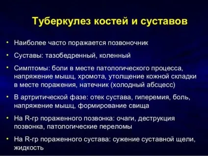 Туберкульоз кісток і суглобів перші ознаки і симптоми, лікування, як передається (туберкульоз кісток) Туберкульоз кісток і суглобів перші ознаки і симптоми, лікування, як передається