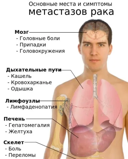 Тромбоцитопенія причини і лікування у дорослих (причини) Тромбоцитопенія причини і лікування у дорослих