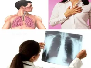 Що робити при фіброзі легенів, мій знахар (робити фіброзі легенів) Що робити при фіброзі легенів, мій знахар