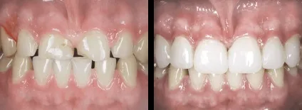 Що таке компонуються і вирішать вони мої проблеми з зубами, nord dental