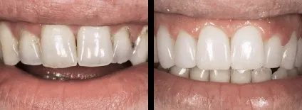 Що таке компонуються і вирішать вони мої проблеми з зубами, nord dental