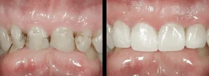 Що таке компонуються і вирішать вони мої проблеми з зубами, nord dental