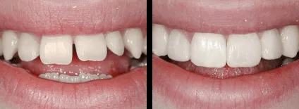Що таке компонуються і вирішать вони мої проблеми з зубами, nord dental