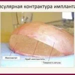 Дабл бабл після маммопластики види і причини (причини) Дабл бабл після маммопластики види і причини
