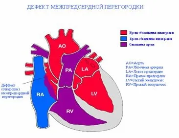 Дефект міжпередсердної перегородки у новонароджених дітей вторинний, первинний