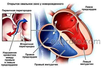 Дефект міжпередсердної перегородки (ДМПП) у дорослих і дітей (ДМПП) Дефект міжпередсердної перегородки (ДМПП) у дорослих і дітей