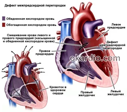 Дефект міжпередсердної перегородки (ДМПП) у дорослих і дітей (дефект) Дефект міжпередсердної перегородки (ДМПП) у дорослих і дітей