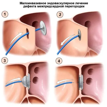 Дефект міжпередсердної перегородки (ДМПП) у дорослих і дітей (перегородки) Дефект міжпередсердної перегородки (ДМПП) у дорослих і дітей