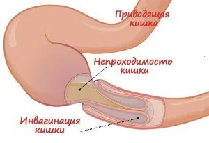 Дієта після операції на кишечнику меню, що можна їсти, рецепти (дієта) Дієта після операції на кишечнику меню, що можна їсти, рецепти