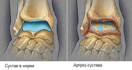 Дієта при артрозі 2