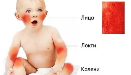 Діатез на руках у дітей (фото) (фото) Діатез на руках у дітей (фото)