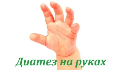 Діатез на руках у дітей (фото) (руках) Діатез на руках у дітей (фото)