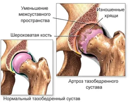 Дієта при артрозі 2