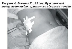 Дренаж печінки необхідність, техніка і наслідки (дренаж) Дренаж печінки необхідність, техніка і наслідки