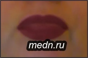 Два основних способи збільшення губ (збільшення) Два основних способи збільшення губ