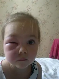 Якщо у дитини набряки під очима