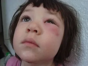 Якщо у дитини набряки під очима