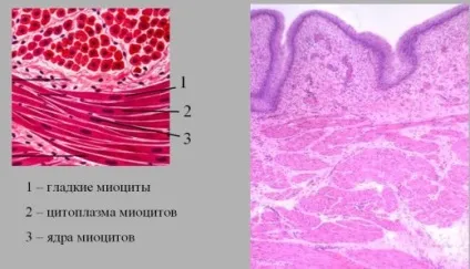 Ендометріоз сечового міхура симптоми, лікування (міхура) Ендометріоз сечового міхура симптоми, лікування