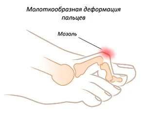 Видалення кісточок (шишок) на ногах в центрі пластичної хірургії «клініка століття»