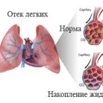 Фіброзно-кавернозний туберкульоз легень - причини, симптоми, лікування (фіброзно-кавернозний) Фіброзно-кавернозний туберкульоз легень - причини, симптоми, лікування