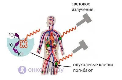 Фотодинамічна терапія, ФДТ в онкології, лікуванні раку (тканини світлового випромінювання) Фотодинамічна терапія, ФДТ в онкології, лікуванні раку