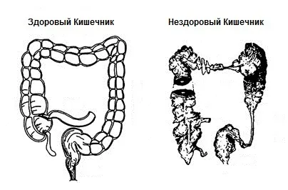 Гідротерапія кишечника, терапевтичну цінність очищення кишечника, обладнання, клініка в Торонто (цінність) Гідротерапія кишечника, терапевтичну цінність очищення кишечника, обладнання, клініка в Торонто
