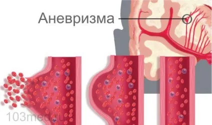 Геморагічний інсульт головного мозку, наслідки після, лікування (правої) Геморагічний інсульт головного мозку, наслідки після, лікування
