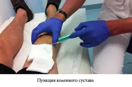Гемартроз колінного суглоба причини, симптоми, лікування і профілактика (профілактика) Гемартроз колінного суглоба причини, симптоми, лікування і профілактика