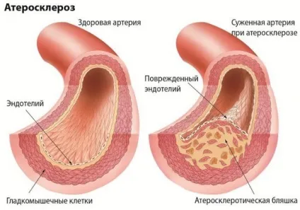 Генералізований атеросклероз причини, симптоми, діагностика, лікування