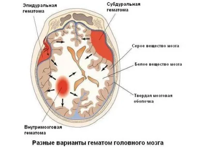 Геморагічний інсульт види, причини виникнення, симптоми, діагностика, лікування, реабілітація та (причини) Геморагічний інсульт види, причини виникнення, симптоми, діагностика, лікування, реабілітація та