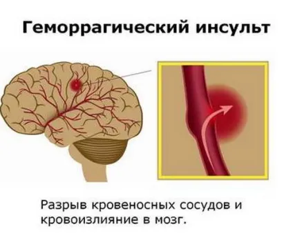 Геморагічний інсульт види, причини виникнення, симптоми, діагностика, лікування, реабілітація та (види) Геморагічний інсульт види, причини виникнення, симптоми, діагностика, лікування, реабілітація та