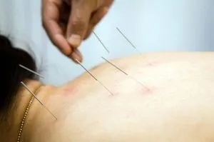 Голкорефлексотерапія при остеохондрозі шийного відділу, відгуки про користь голковколювання
