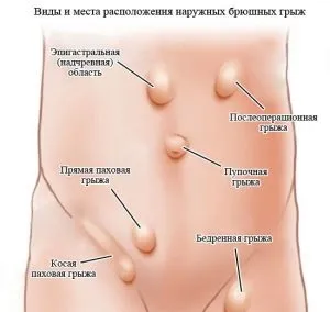 Грижа живота лікування народними засобами патології (засобами) Грижа живота лікування народними засобами патології