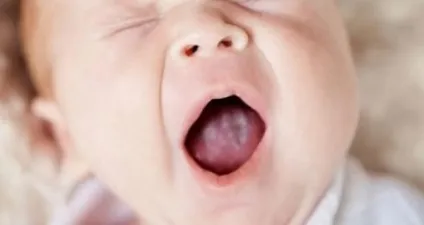 Грибок в роті у дорослих і дитини лікування медикаментозне (грибок) Грибок в роті у дорослих і дитини лікування медикаментозне