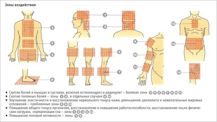 Голковколювання при остеохондрозі шийного, поперекового відділу (поперекового) Голковколювання при остеохондрозі шийного, поперекового відділу