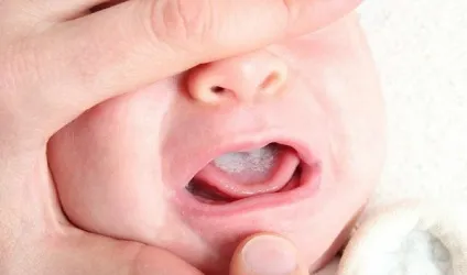 Грибок в роті у дорослих і дитини лікування медикаментозне (лікування грибка) Грибок в роті у дорослих і дитини лікування медикаментозне