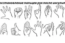 Інсульт у дітей причини і симптоми