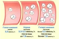 Інсулінозалежний цукровий діабет етіологія, клініка, лікування (інсулінозалежний) Інсулінозалежний цукровий діабет етіологія, клініка, лікування