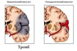 Інсульт у дітей причини і симптоми