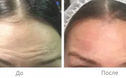 Ін'єкції ботокса (botox) в москві за низькими цінами - клініка telo s beauty (цінами) Ін'єкції ботокса (botox) в москві за низькими цінами - клініка telo s beauty