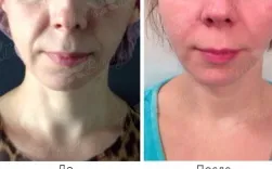 Ін'єкції ботокса (botox) в москві за низькими цінами - клініка telo s beauty (ботокса) Ін'єкції ботокса (botox) в москві за низькими цінами - клініка telo s beauty