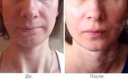 Ін'єкції ботокса (botox) в москві за низькими цінами - клініка telo s beauty (ін'єкції) Ін'єкції ботокса (botox) в москві за низькими цінами - клініка telo s beauty