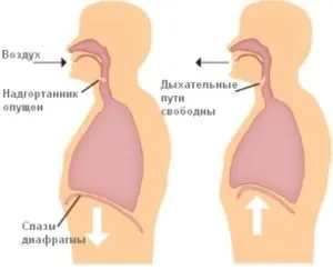 Гикавка що таке і від чого буває, різновиди та ускладнення (гикавка) Гикавка що таке і від чого буває, різновиди та ускладнення