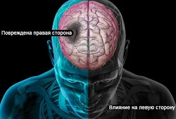 Інсульт правого боку