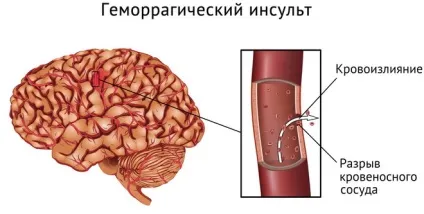 Інсульт права сторона наслідки, скільки живуть і способи профілактики (права) Інсульт права сторона наслідки, скільки живуть і способи профілактики