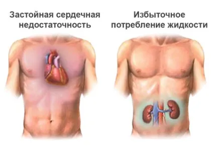 Інсулінозалежний цукровий діабет - що це і як з ним управлятися (діабет) Інсулінозалежний цукровий діабет - що це і як з ним управлятися