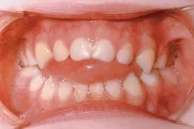 Виправлення прикусу брекети або пластинка, perfectsmile (прикусу) Виправлення прикусу брекети або пластинка, perfectsmile