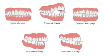 Виправлення прикусу у дітей пластина, трейнер, капа і брекети для виправлення непрваліного прикусу (пластина для виправлення прикусу у дітей фото) Виправлення прикусу у дітей пластина, трейнер, капа і брекети для виправлення непрваліного прикусу