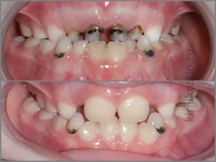 Виправлення прикусу брекети або пластинка, perfectsmile (прикусу) Виправлення прикусу брекети або пластинка, perfectsmile