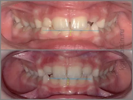 Виправлення прикусу брекети або пластинка, perfectsmile (ортодонтія) Виправлення прикусу брекети або пластинка, perfectsmile